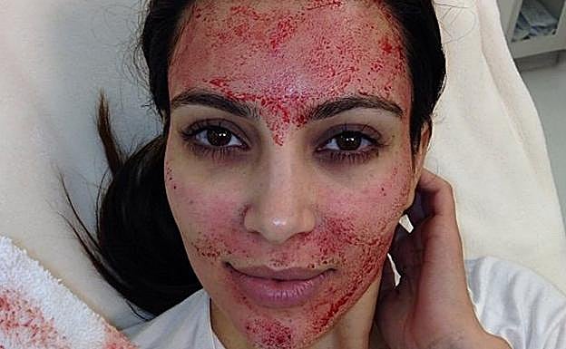 Kim en el momento de someterse a la técnica 'Vampire facial' en 2013. 