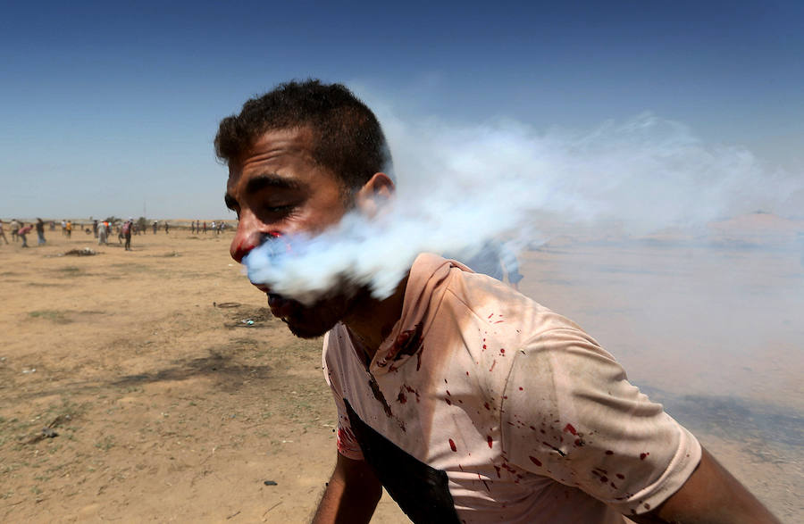 Un palestino herido en la cara por una botella de gas lacrimógeno durante las protestas en la frontera entre Israel y Gaza. 
