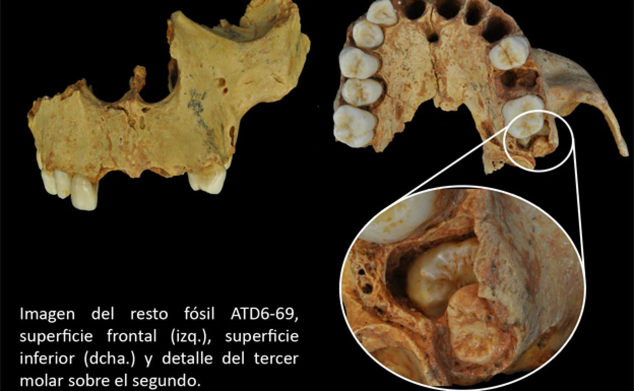 El Homo antecesor hallado en Atapuerca ya padecía problemas derivados de no poseer el espacio suficiente para la muela del juicio 