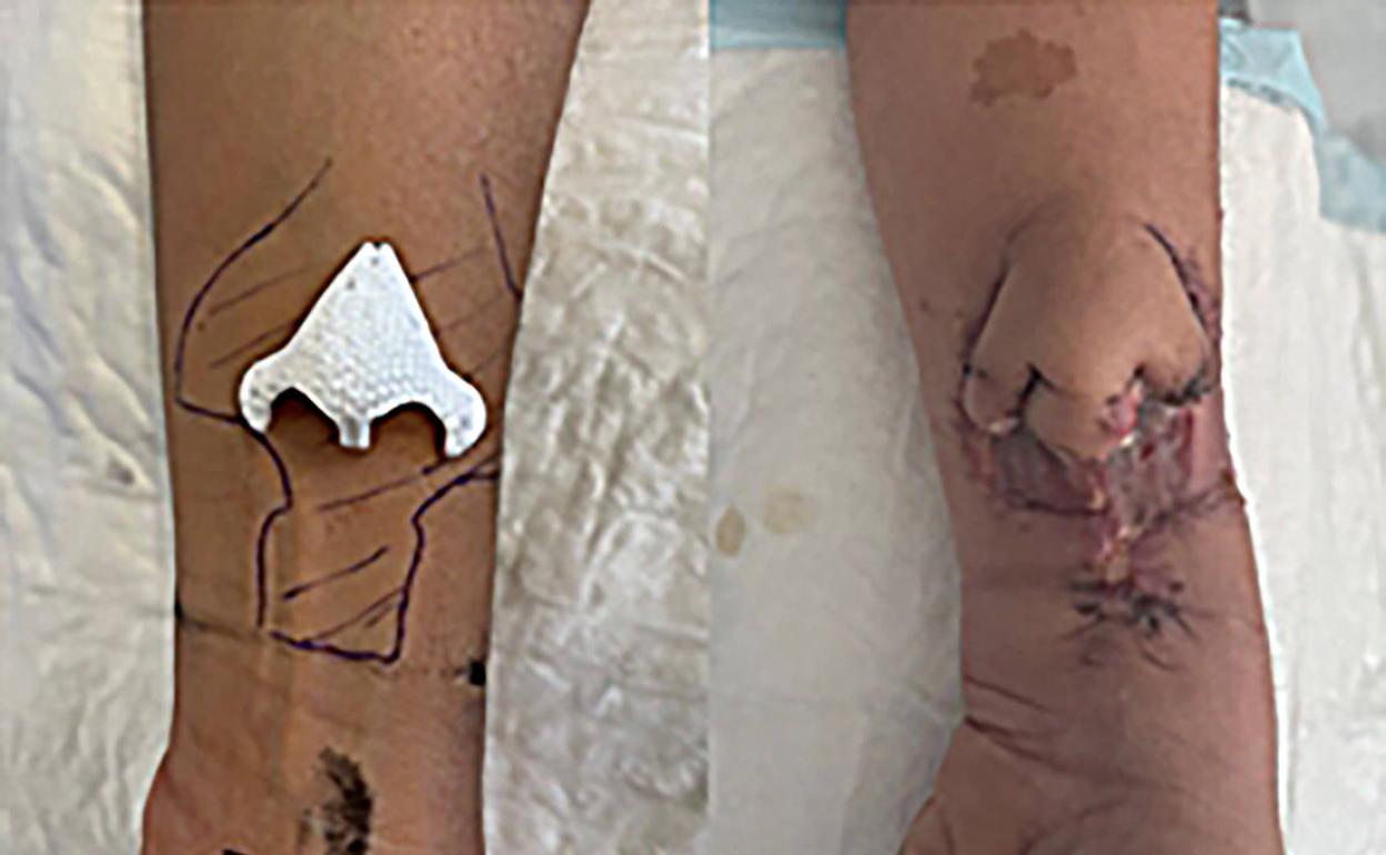 Dos imágenes de la prótesis de nariz implantada en el antebrazo de la paciente