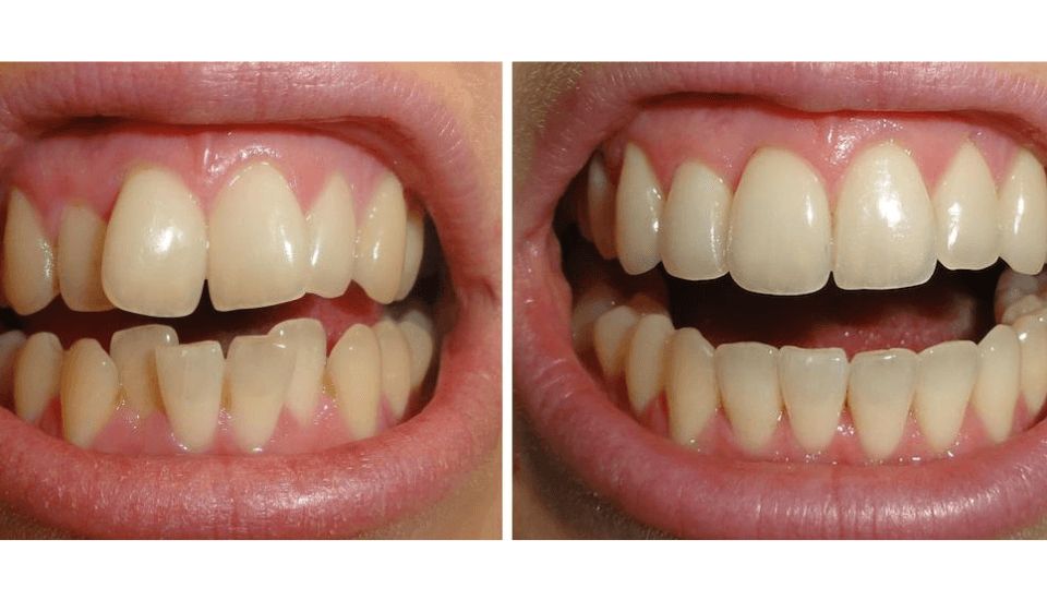 Antes y después del tratamiento Invisalign.