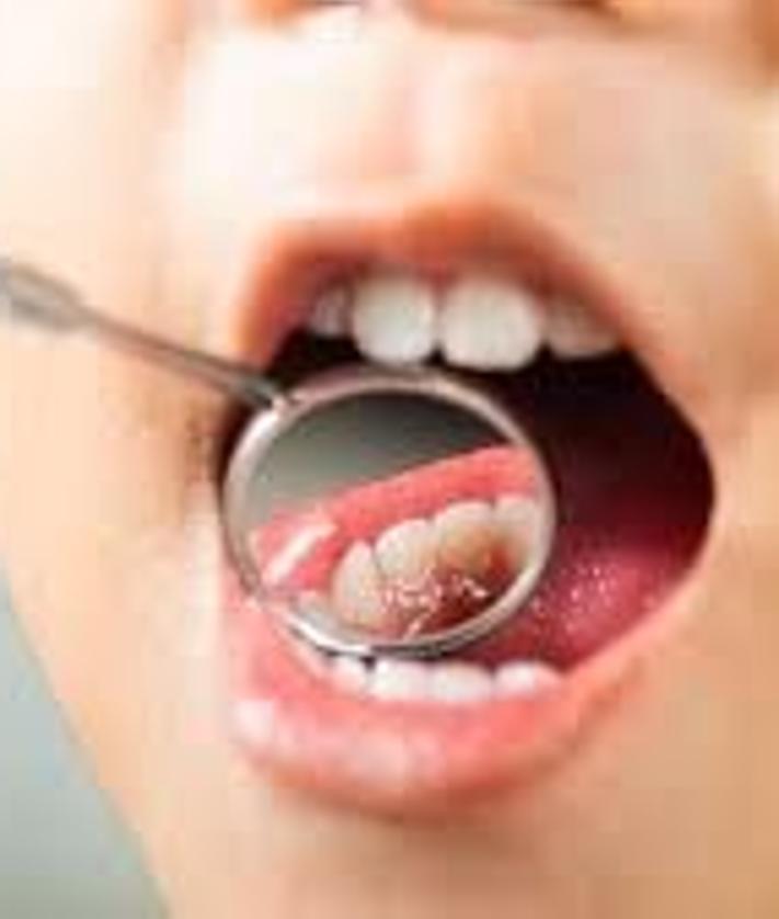 Imagen secundaria 2 - Mitos y leyendas sobre la salud bucodental