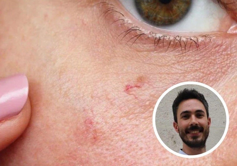 Imagen de la piel del rostro con manchas. En el círculo el experto en dermocosmética Alberto León.