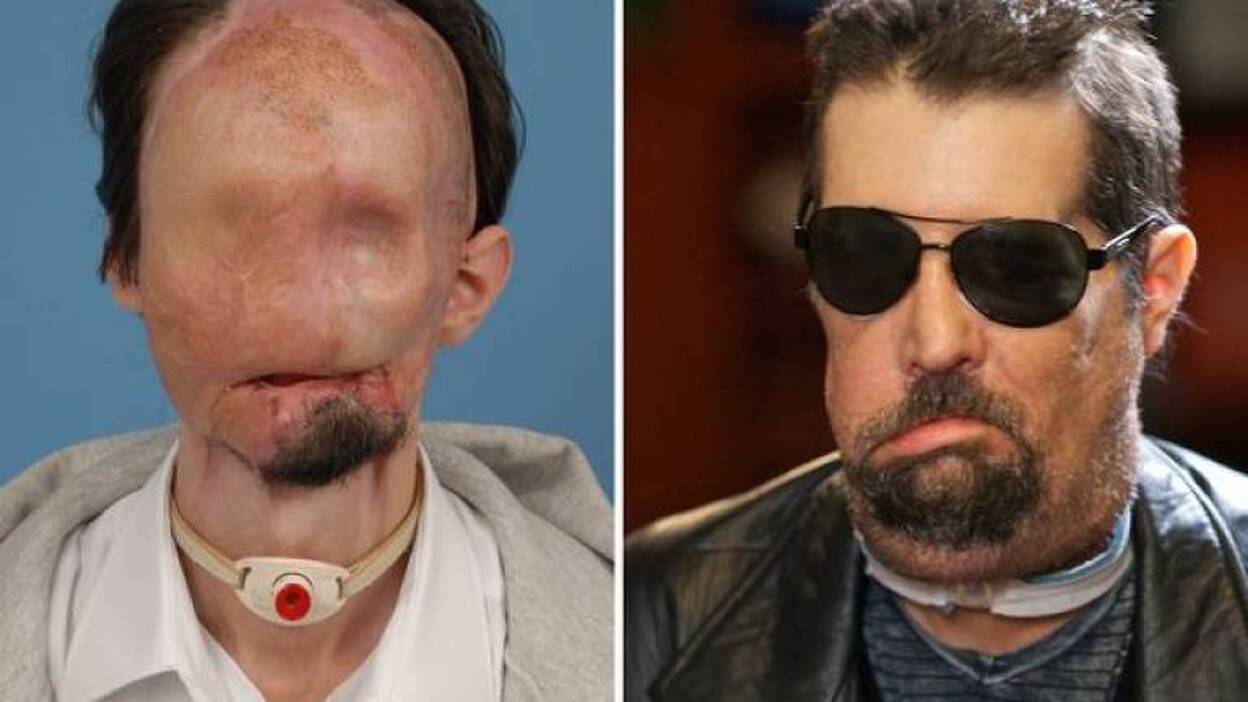 Aparece en público el primer trasplantado total de cara en EEUU