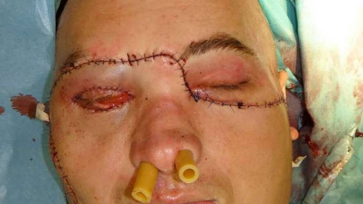 Realizan con éxito el primer trasplante de cara total en Polonia