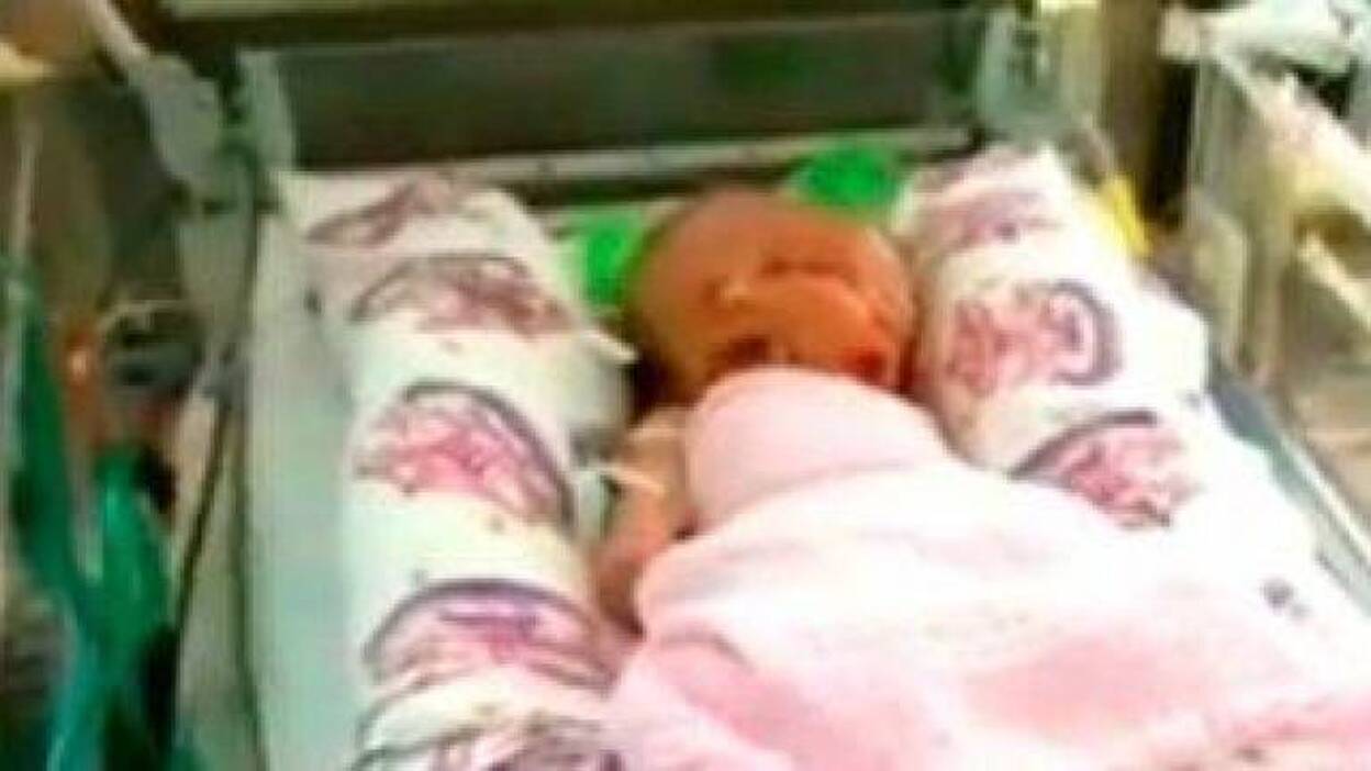 Unas mellizas con dos caras en un solo cráneo nacen en Australia