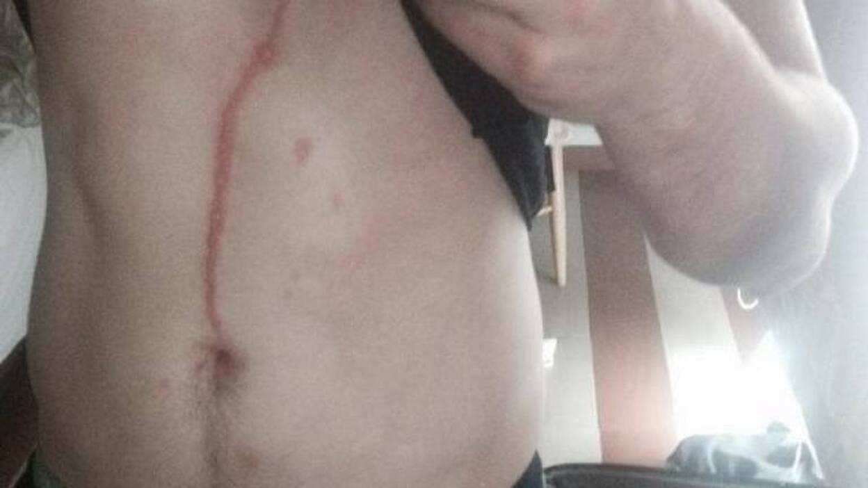 Una araña excavó en el pecho de un turista en Indonesia