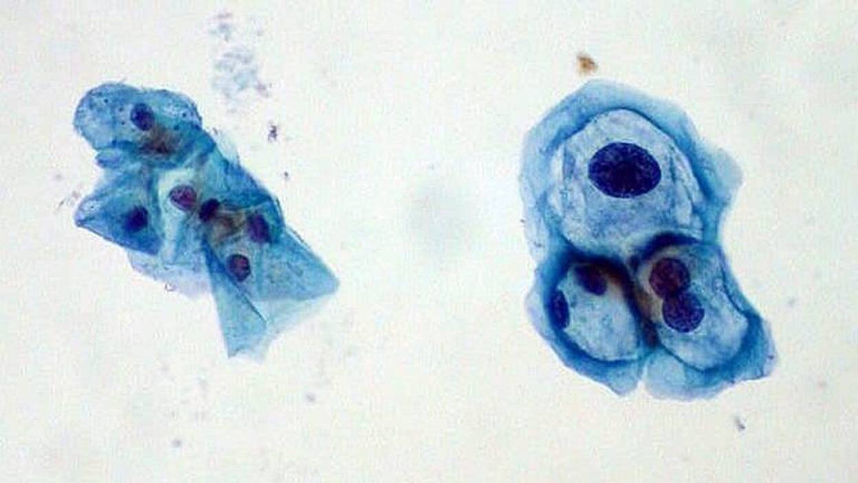 Confirman que el virus del papiloma también causa cáncer de garganta