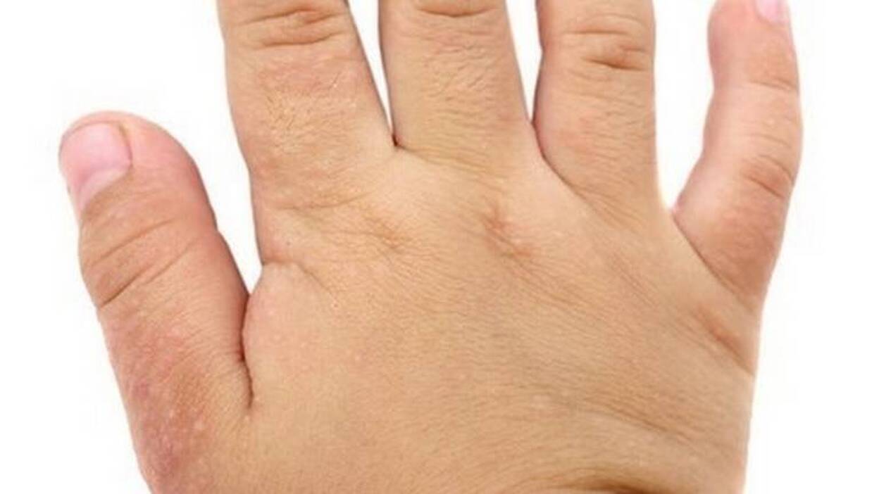 La dermatitis atópica en niños empeora durante el invierno