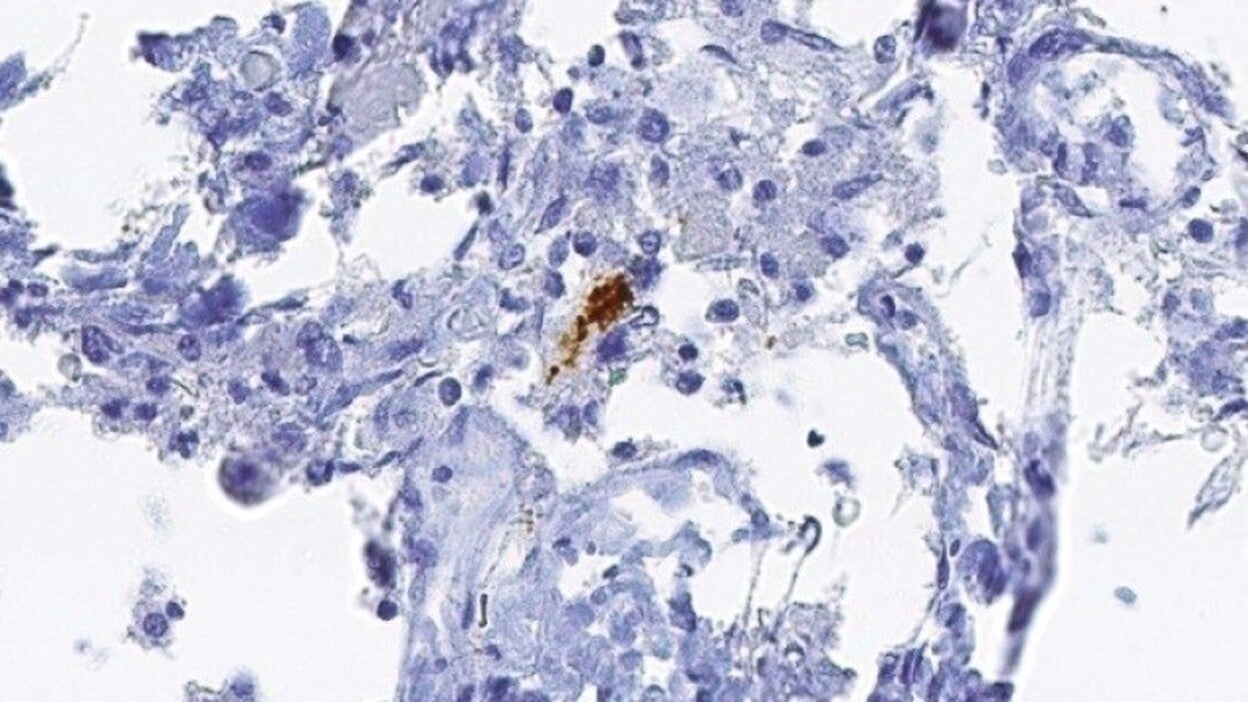 Identifican una nueva vía de muerte cerebral del Alzheimer