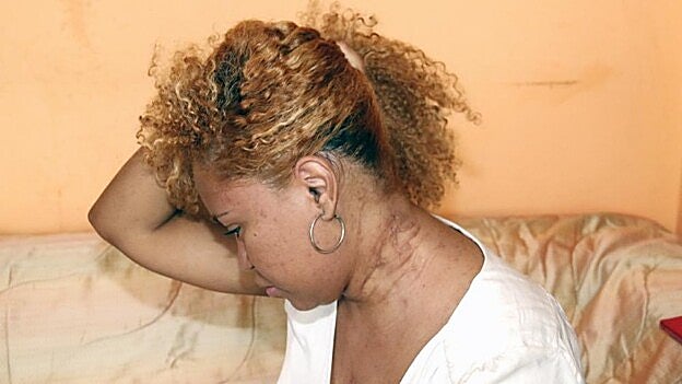 La agredida muestra las severas cicatrices que le dejó en el cuello el  serraje  con el que su marido intentó matarla
