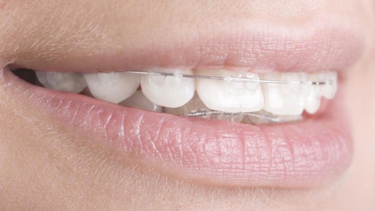 Cinco de cada diez españoles llevan o han llevado ortodoncia