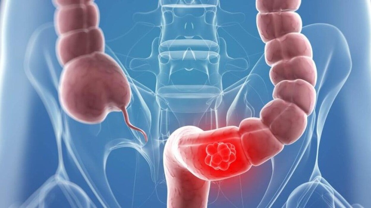 Detectar a tiempo el cáncer de colon cuesta 182 euros