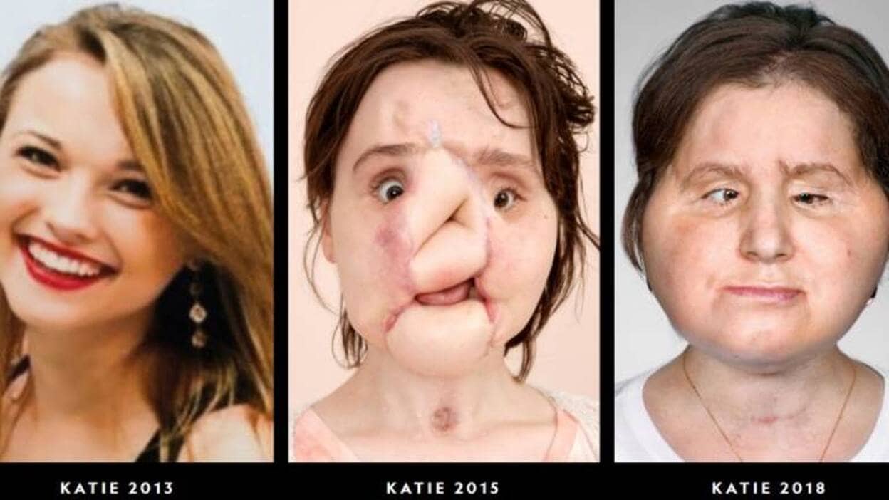 El trasplante de cara que ha sorprendido al mundo