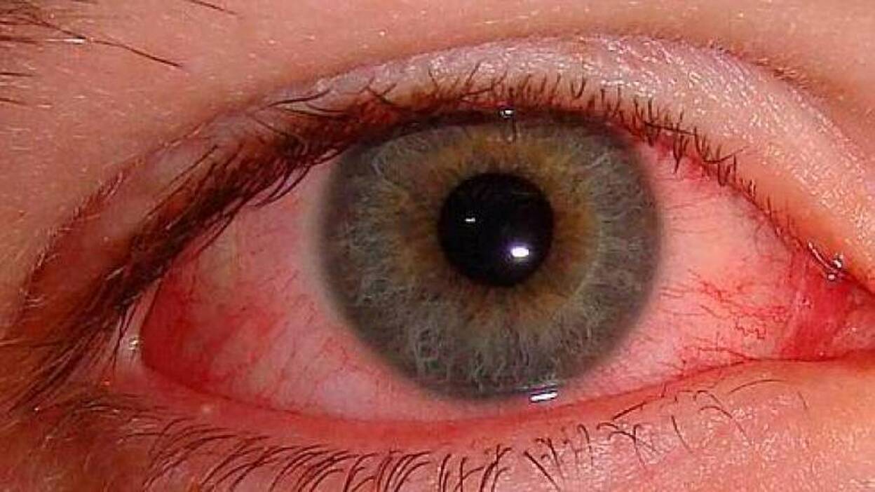 La conjuntivitis, otro posible síntoma del coronavirus