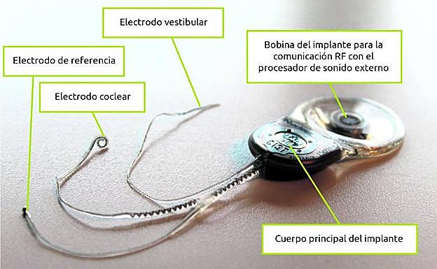Implante diseñado por el equipo de Ingenieros del SIANI de la Universidad de Las Palmas. 