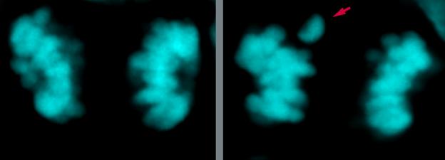 Lado izquierdo: imagen microscópica de los cromosomas (en cian) de una célula madre neural humana moderna de la neocorteza durante la división celular. Lado derecho: mismo tipo de imagen, pero de una célula donde tres aminoácidos en las dos proteínas KIF18A y KNL1, han sido cambiadas del humano moderno a las variantes neandertales. Estas células 'neandertalizadas' muestran el doble de errores de separación cromosómica (flecha roja).