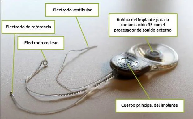 Implante vestibular diseñado por la ULPGC. 