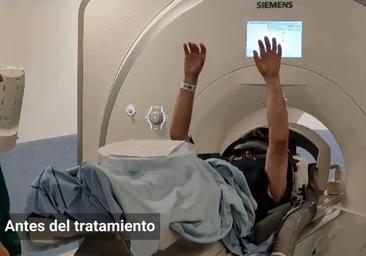 Así se obró el milagro: cómo funciona el tratamiento contra el temblor esencial