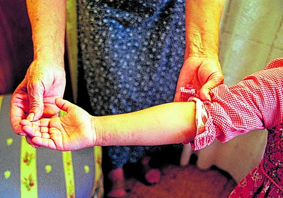 Imagen de archivo de una niña afectada de sarna en la capital grancanaria.