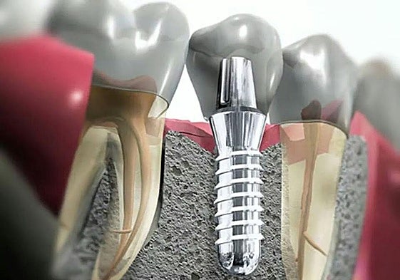 Implantes Dentales para personas mayores ¿es arriesgado?