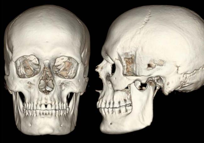 Imagen del cráneo del guanche, donde se aprecia la dentadura sin imperfecciones.