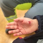 Mordedura en la mano de la víctima