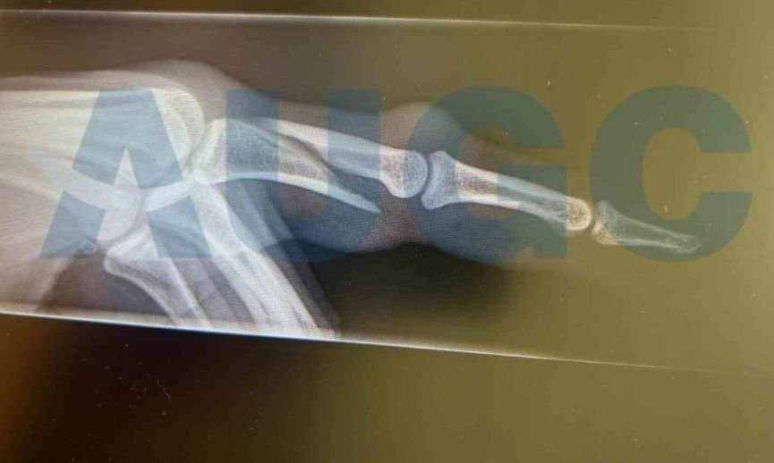Imagen de la radiografía de la fractura del agente de la Guardia Civil.