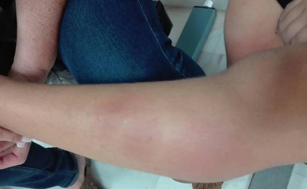 Enésima denuncia de los padres de alumnos de un colegio de Vélez por picaduras de pulgas