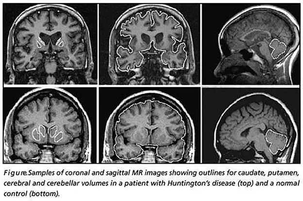 Imágenes de un cerebro afectado por la enfermedad de Huntington (arriba) y abajo, un cerebro sano. :: R. C.