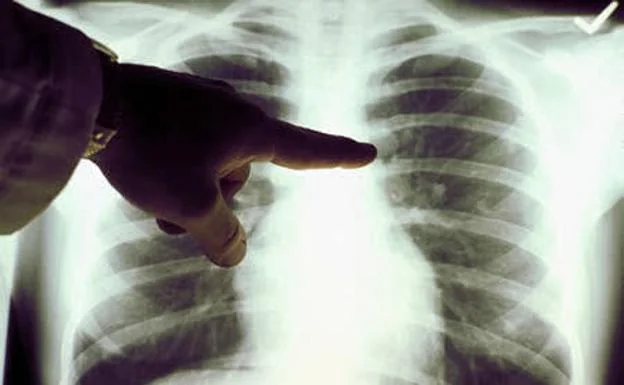 Las muertes por cáncer de pulmón en mujeres se triplican en 20 años