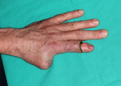 Imagen secundaria 1 - Francisco Piñal y su equipo, en el quirófano de La Luz. Abajo, dos imágenes de dedos trasplantados del pie a la mano. 