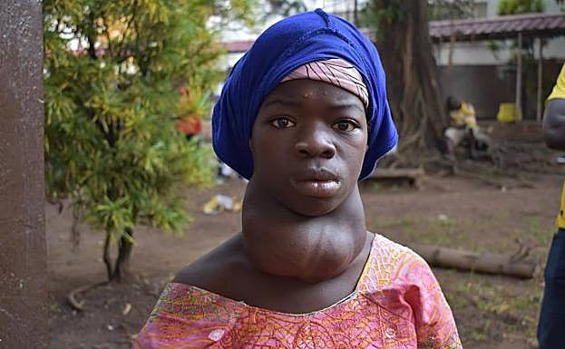 Galería. Paciente tiroide Sierra Leona antes de ser operada
