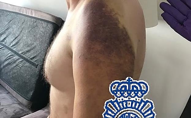 Hematomas que presentaba el secuestrado.