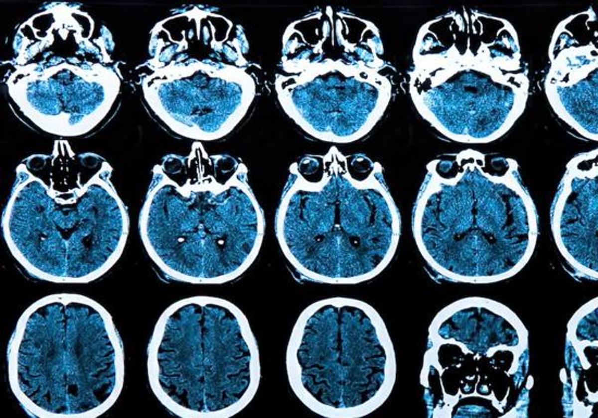 Investigadores malagueños descubren avances clave para tratar el glioblastoma, el cáncer cerebral más agresivo