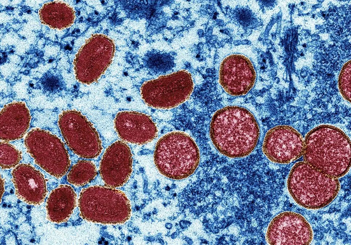 Cómo se contagia y cuáles son los síntomas de la viruela del mono