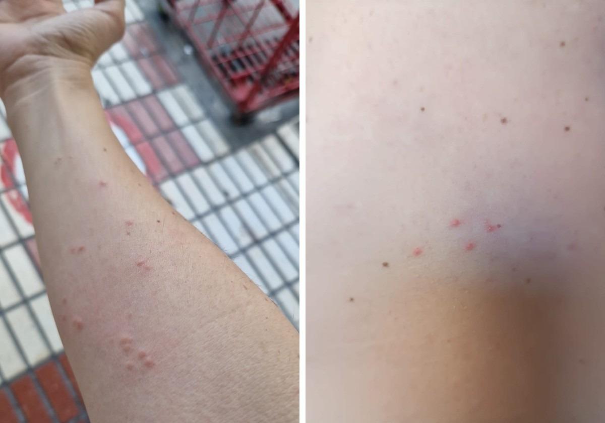 Una plaga de chinches o pulgas en el Hospital Regional de Málaga afecta ya a 17 sanitarios