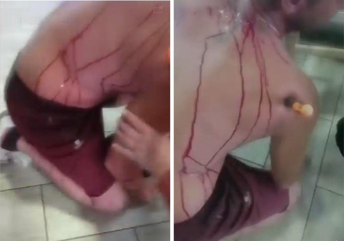 Apuñalamiento en Mijas: le clava un destornillador y se lo deja incrustado en el hombro
