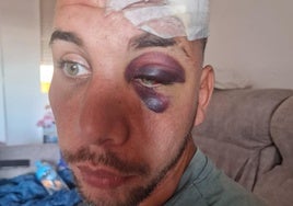 Eduardo busca la furgoneta que lo dejó grave tras tirarlo de su patinete en Benalmádena