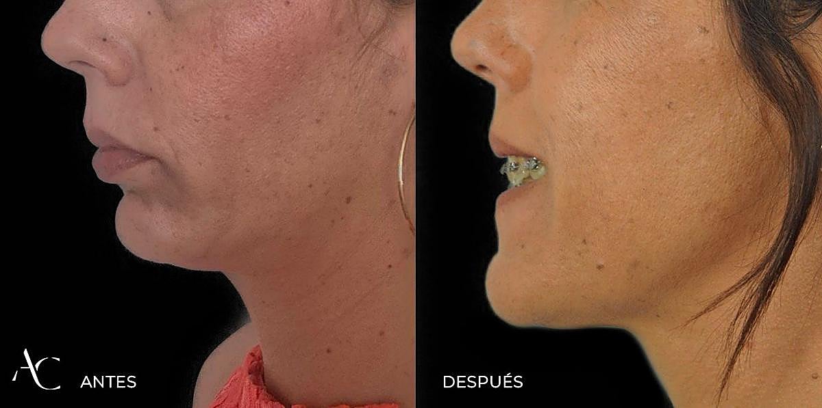 Jaw Surgery Shift: Aesthetics Now Drive 50% of Procedures | Malaga, Spain