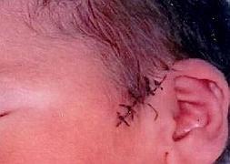 Cesárea para la madre... y 16 puntos de sutura para el bebé