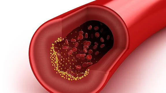 Colesterol en una arteria.