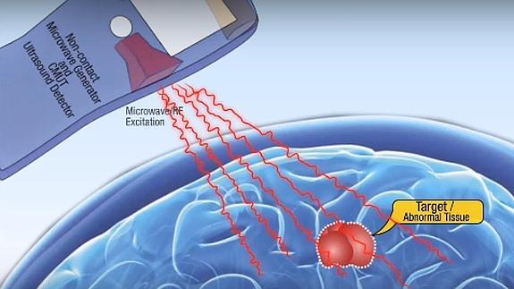 El dispositivo utiliza ondas microondas para detectar un cáncer.