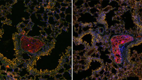 Células metastásicas de cáncer de mama (en rojo).