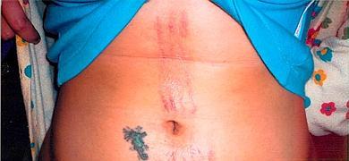 Quemaduras sufridas por la joven en el abdomen tras el tratamiento de fotodepilación recibido en una clínica estética. ::                             SUR