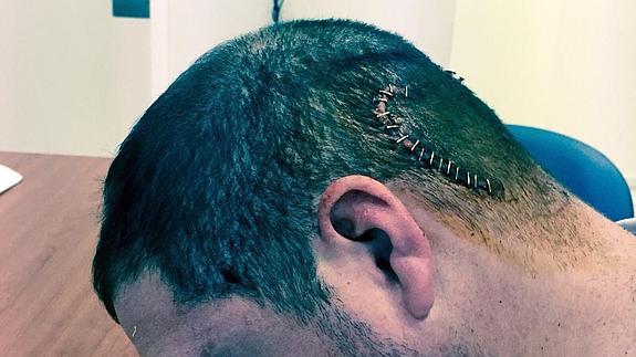 Brecha sufrida por uno de los jóvenes tras la última agresión.