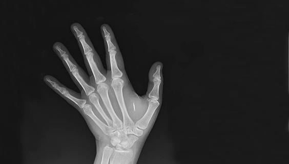 En la radiografía de esta mano aparece un hueso de más. Su nombre es chip. 