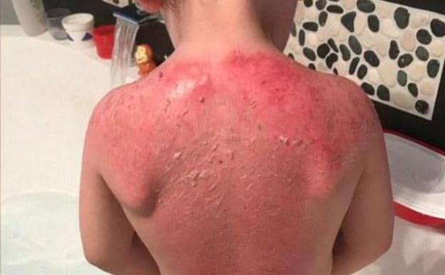 Un niño de tres años sufre graves quemaduras tras usar un protector solar de Peppa Pig