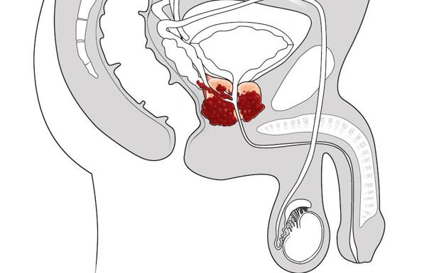 Algunos nervios impulsan el cáncer de próstata