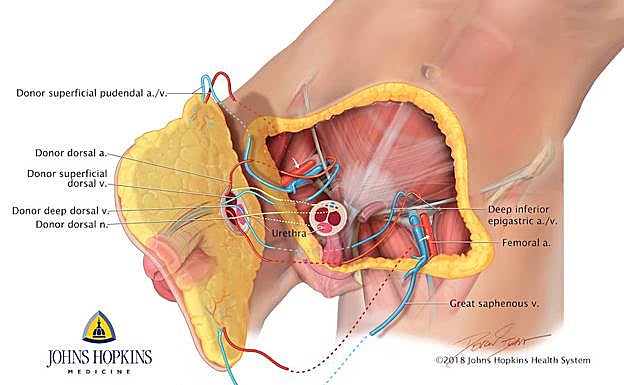 Imagen principal - Un dibujo del primer trasplante de pene y escroto realizado por la Facultad de Medicina de la Universidad Johns Hopkins. El equipo médico y Wei-Ping Andrew Lee